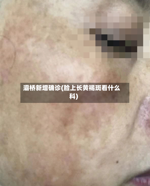 灞桥新增确诊(脸上长黄褐斑看什么科)